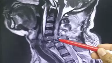 Hapşırığını tutmaya çalıştı nefes borusunu yırttı! Doktorlar bunun bir ‘ilk’ olduğunu söylüyor