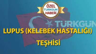 Lupus (Kelebek hastalığı) teşhisi