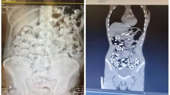 Böylesi görülmedi! Doktorlar şaşkın