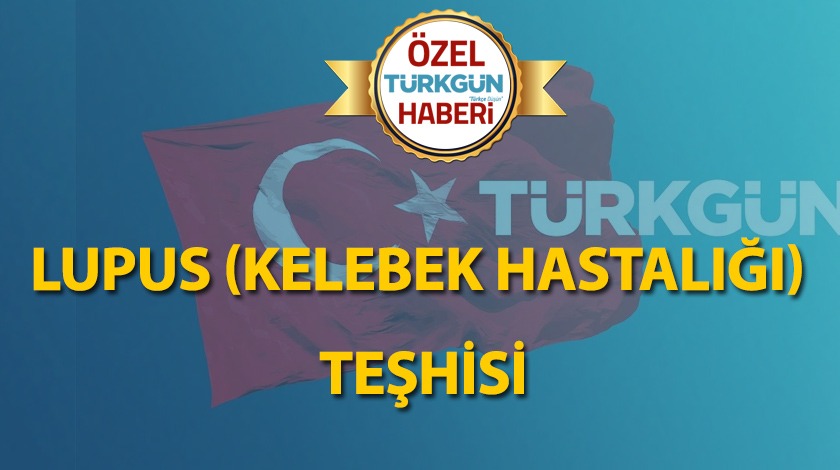 Lupus (Kelebek hastalığı) teşhisi