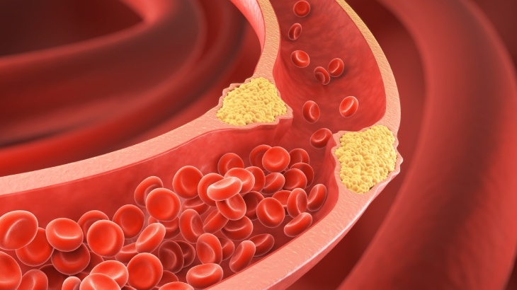 Yüksek Kolesterol ve Kalp Hastalığı: Nasıl Önlenir? - Acıbadem Hayat